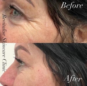 Before and after picture for Crows feet with Botox