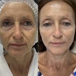 Polynucleotide treatment before and after picture
