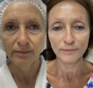 Polynucleotide treatment before and after picture