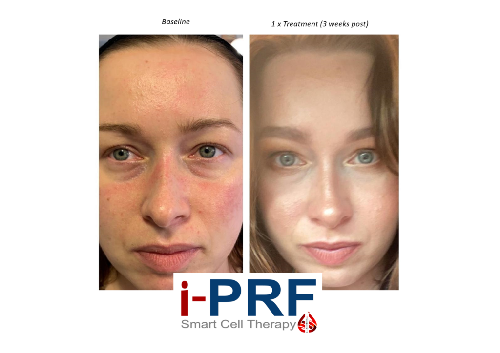 Under eye before and after treatment with PRF