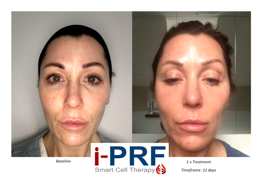 PRF,PRP treatment