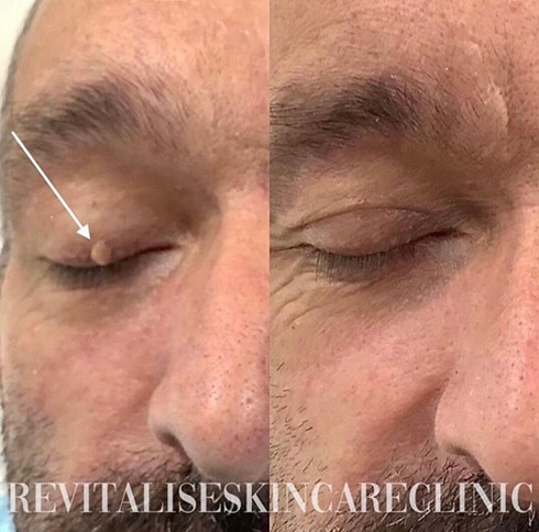 Mole and tag removal