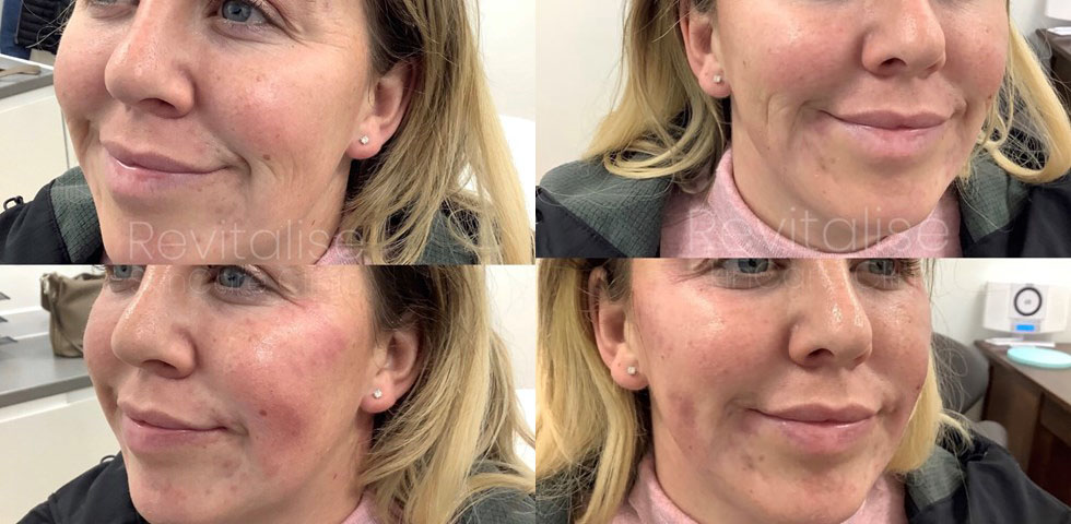 Skin booster before and after picturestreatment