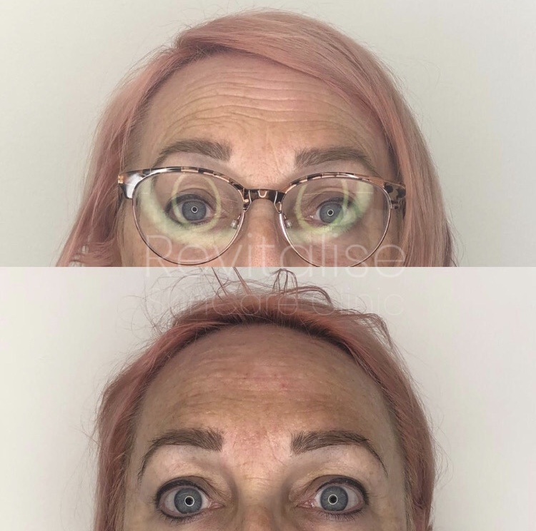 Skinbooster injection before and after picture treatment