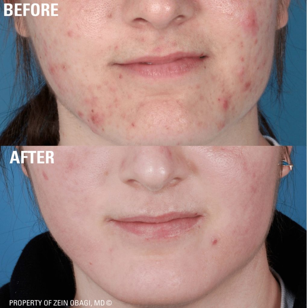Acne prescription treatment before and after