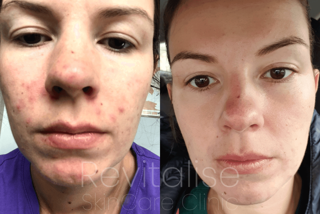 Plasma Therapy Acne Care
