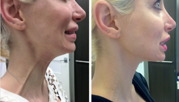 Platysma band treatment before and after picture