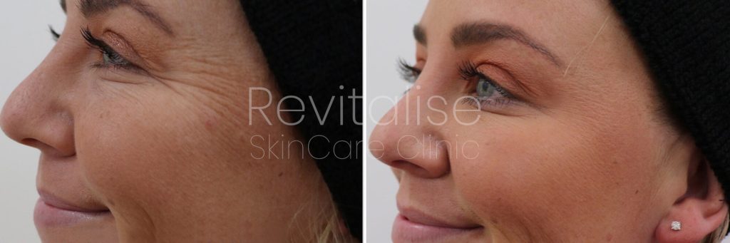 Lines around eye area treatment