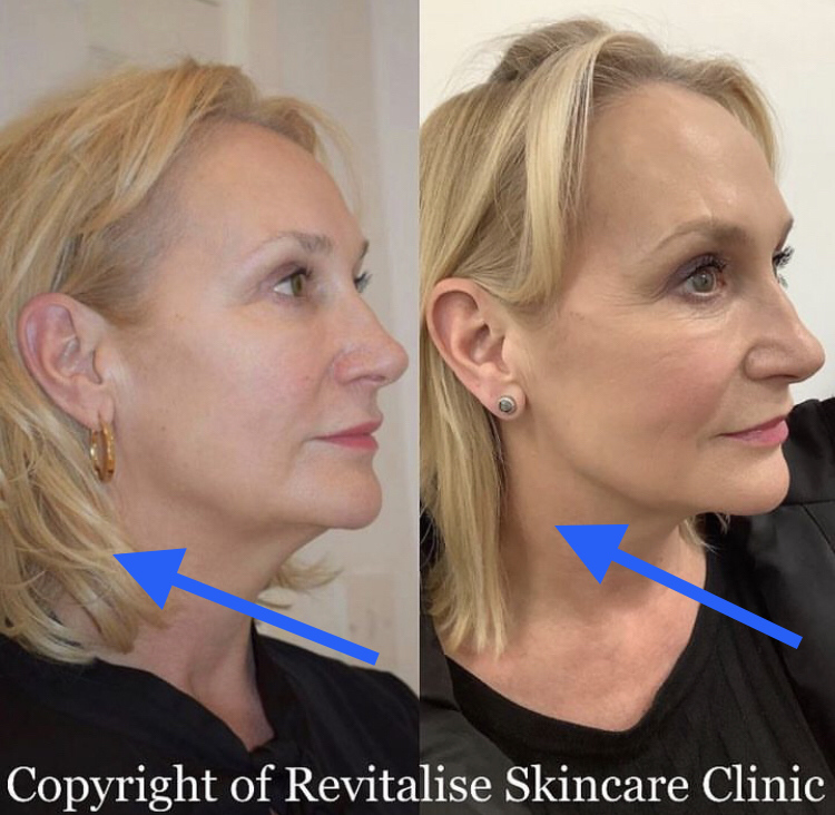 Non surgical face lift with PDO threads