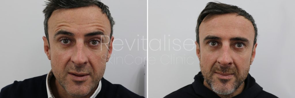 Botox before and after pictures for forehead