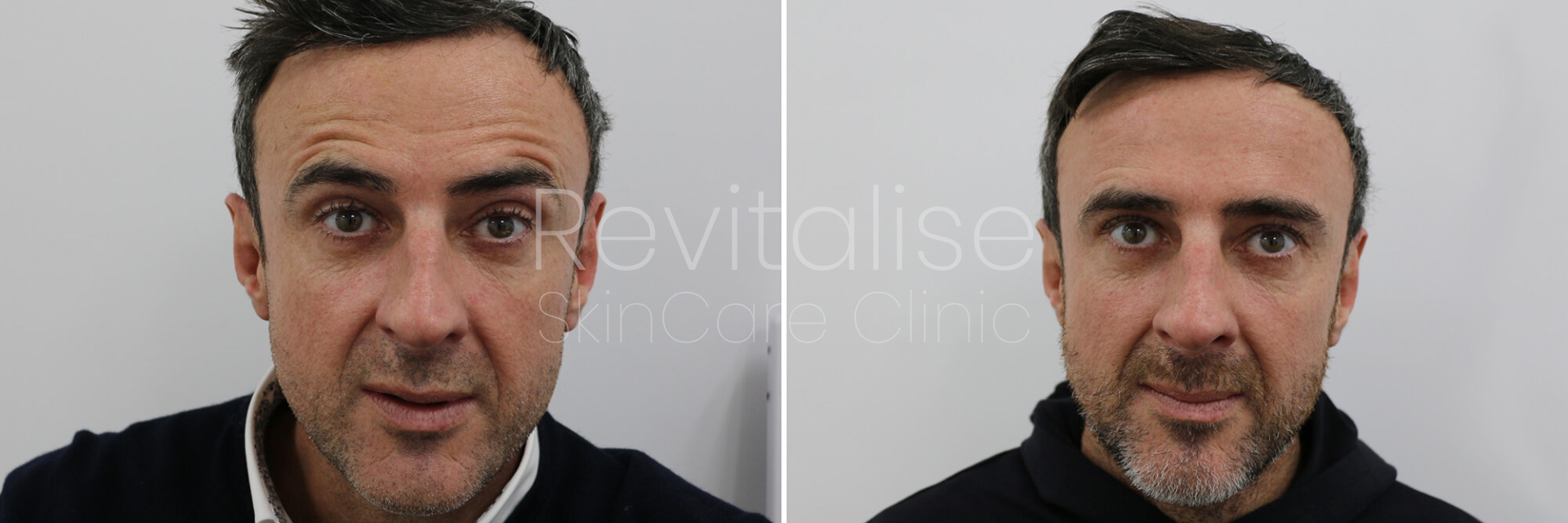 befor and after image of a male forehead botox treatment