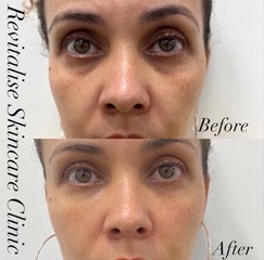 Before and after pictures for hollow under eyes