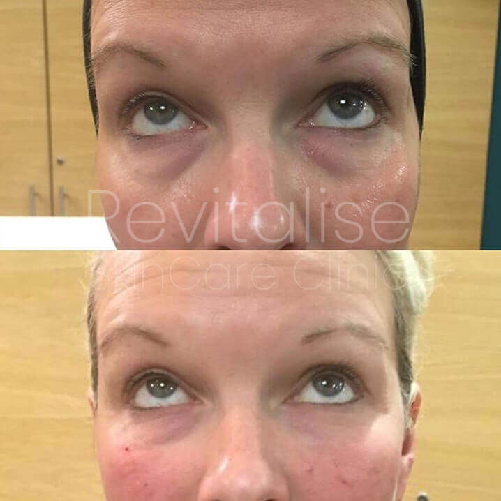 Hollow under eyes treatment before and after picture