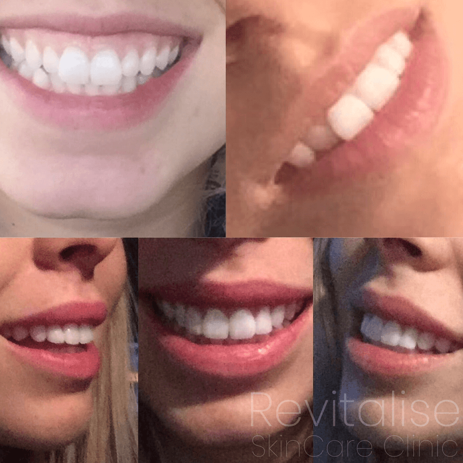 Gummy smiles before and after treatment