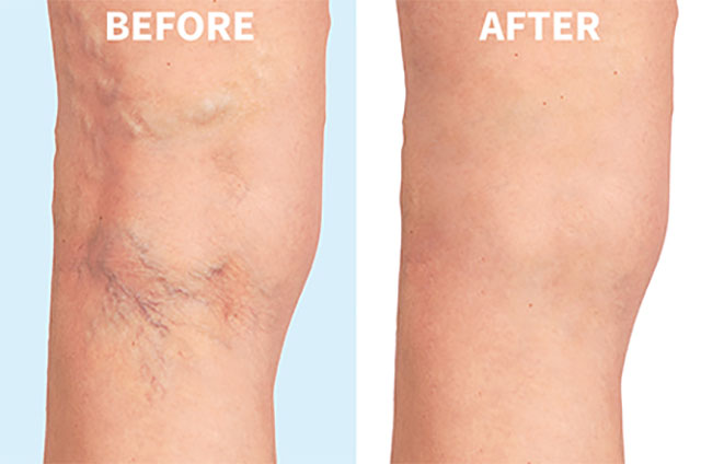 Before and after picture for microsclerotherapy