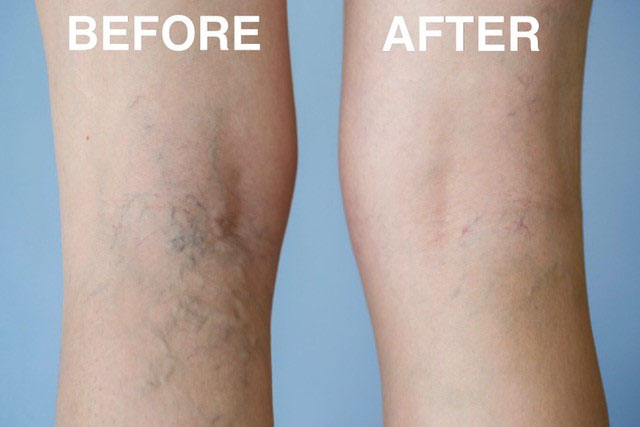 Microsclerotherapy treatment before and after picture