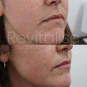 mole removal before and after pictures - lesion removal