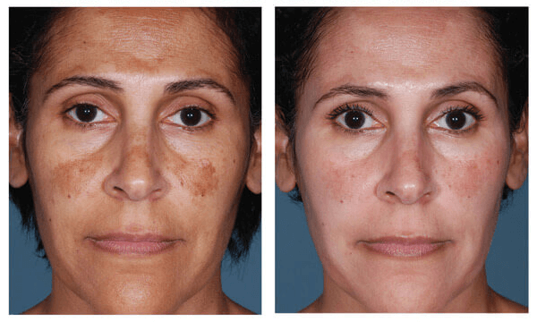 Hyperpigmentation prescription skincare before and after pictures