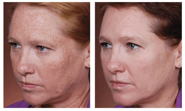 Hyperpigmentation treatment