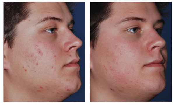 ACNE treatment