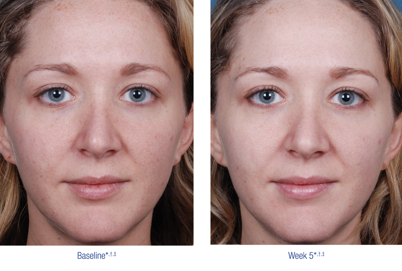 Chemical peel
