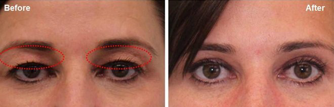 Before and after comparison of non surgical upper eyelid Blepharoplasty treated with Plasma BT showing visible rejuvenation.