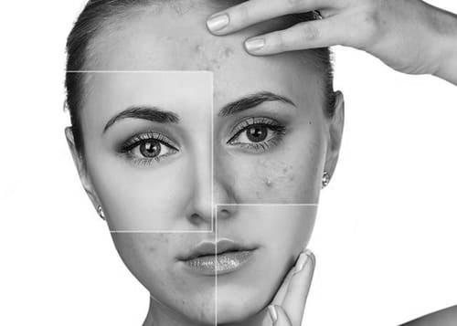 Acne treatment