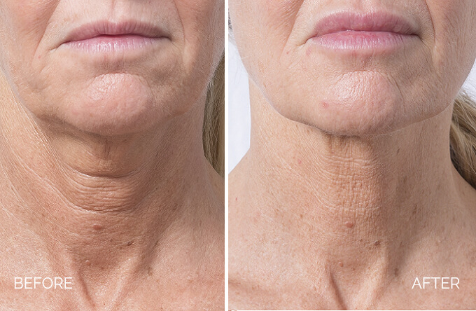 Skin booster injection ,Profhilo treatment