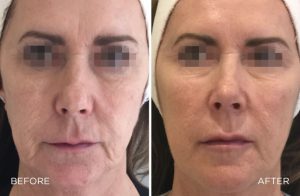 Profhilo treatment