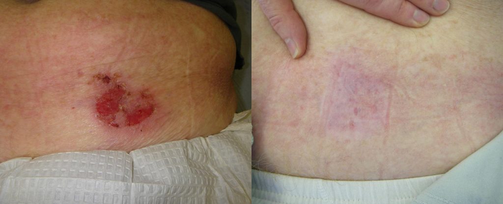 Photo Dynamic therapy