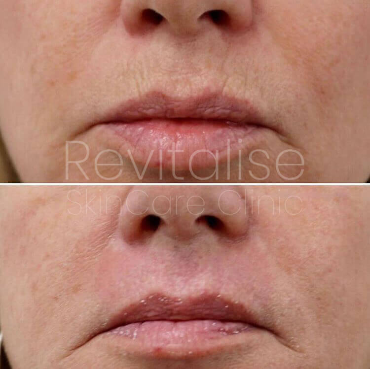 Before and after comparison of smokers lines treated with Plasma BT showing visible rejuvenation.