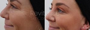 Botox crows feet eyes