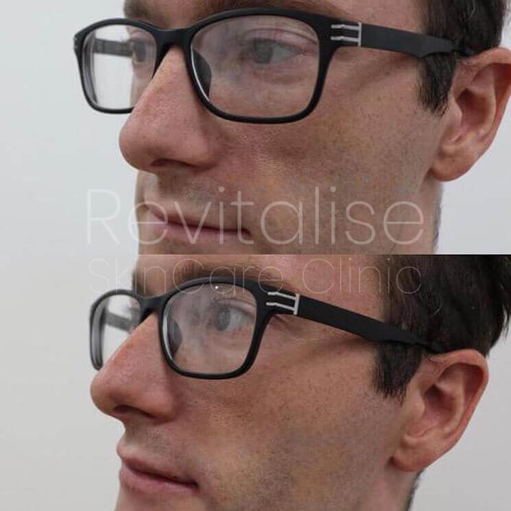 lip enhancement of male before and after image