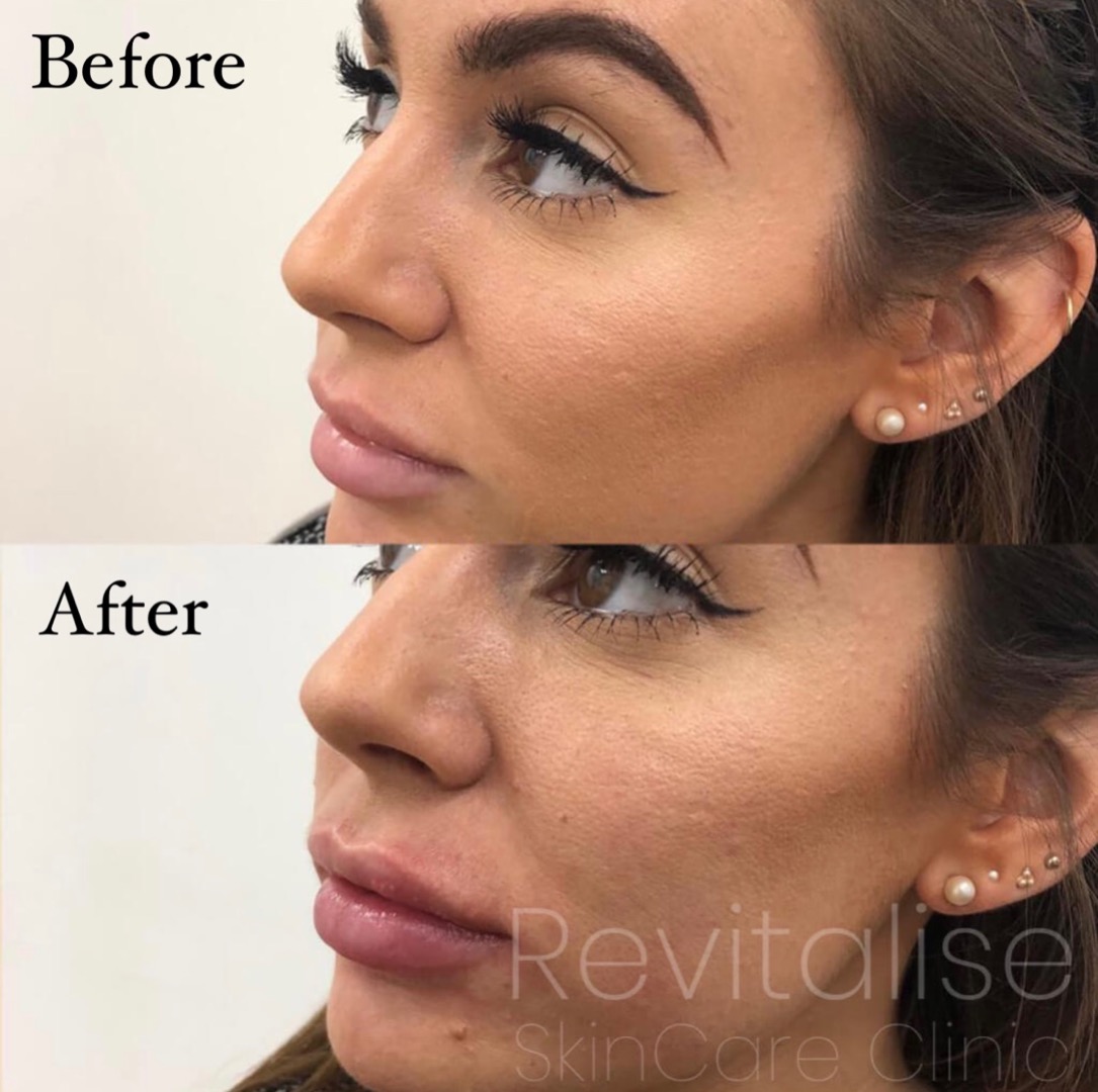 lip fillers before and after of a female in bath clinic