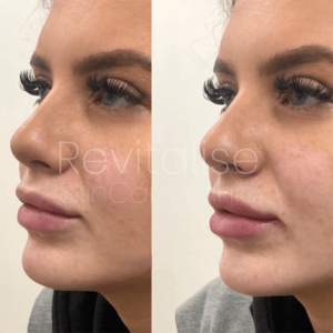 Lip enhancement before and after picture