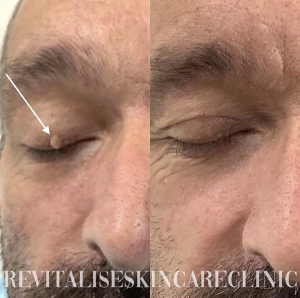 Before and after picture for tag removal