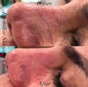 Thread vein removal before and after picture