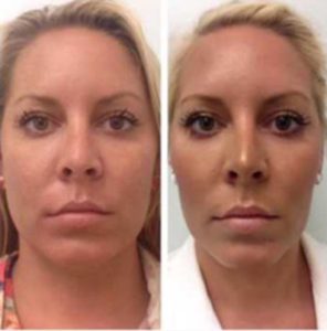 Botox