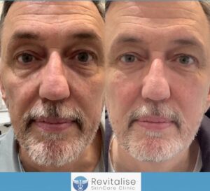 Dermal fillers in Bath,Somerset ,Wiltshire