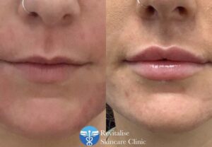 Lip filler treatment