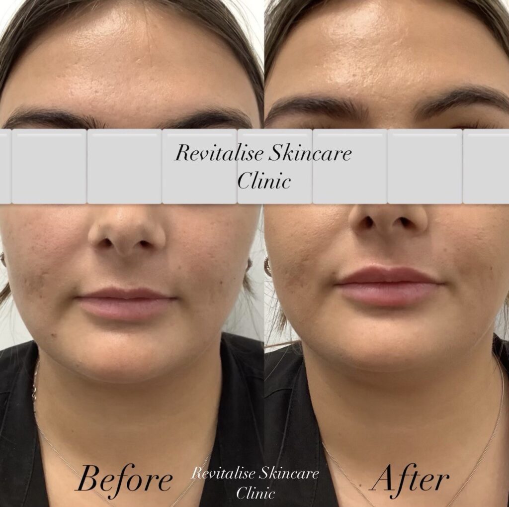 Natural lip filler treatment