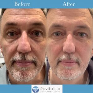 ageing eyes treatment for men