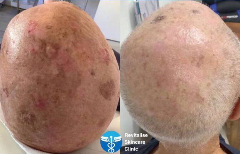 Before & After Actinic keratoses & BCCs