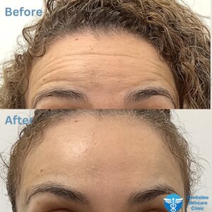Botox forehead lines - How long does Botox last on the forehead?