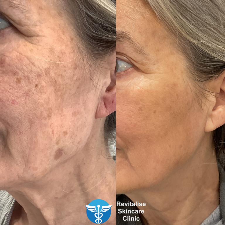 befor and after Photodynamic Therapy