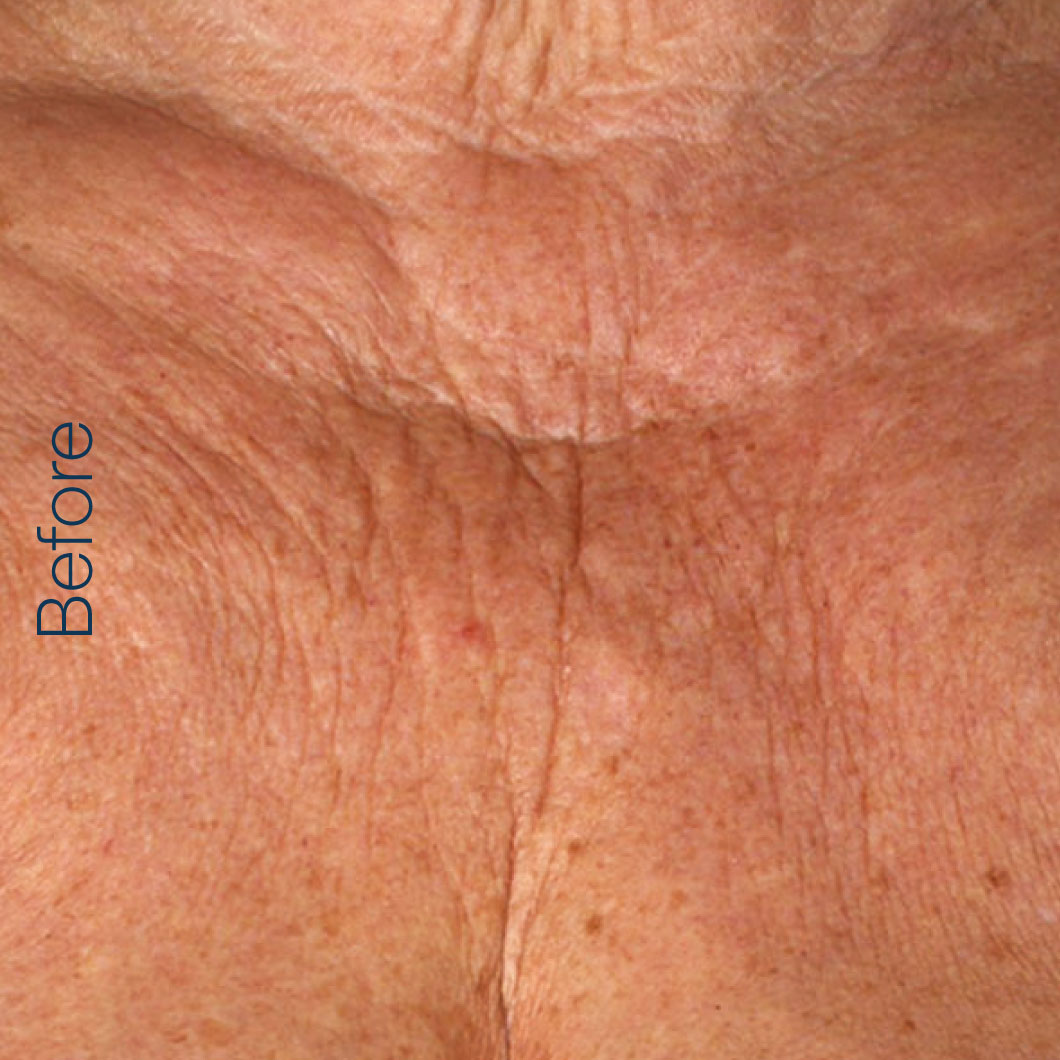 Radiesse - decollete before
