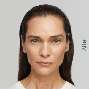 Radiesse - Ewa after