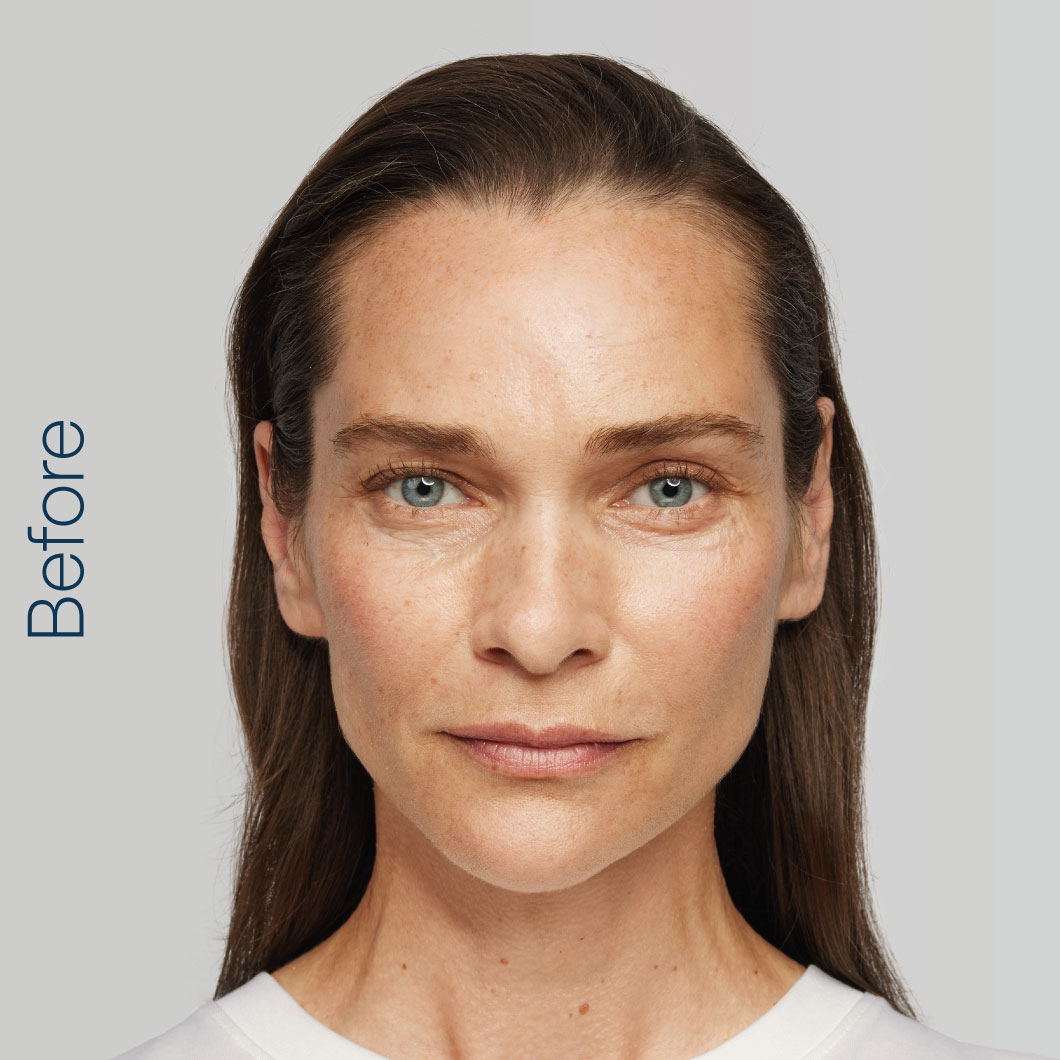 Radiesse - Ewa Before
