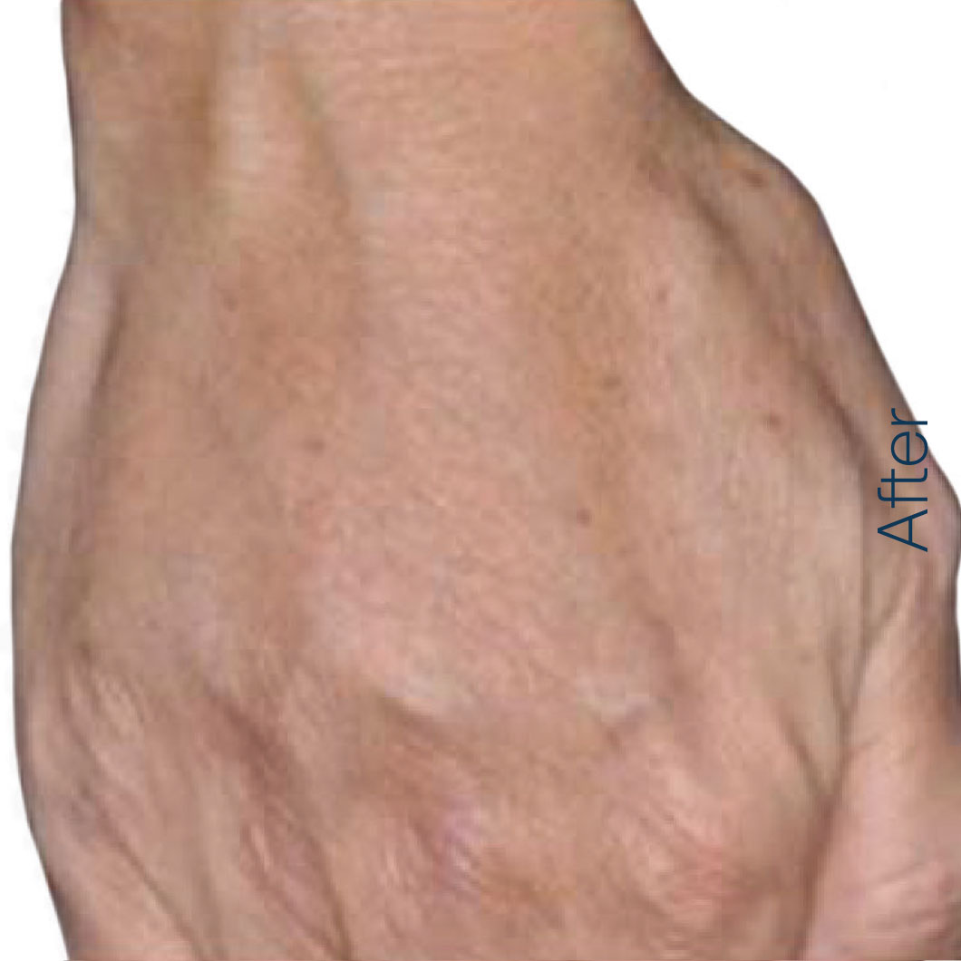 Radiesse - Hand after