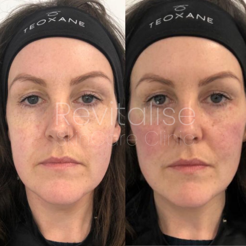 Face reshaping treatment before and after picture